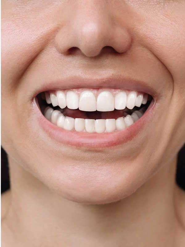 Etter tannregulering